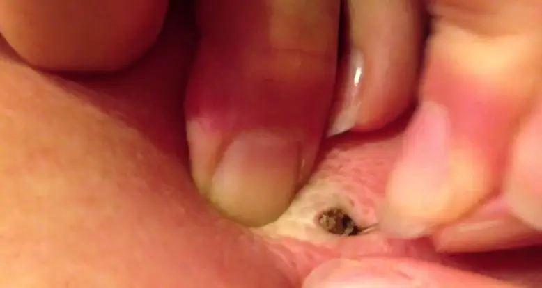 Gigantic 25 Year Old Blackhead Removed