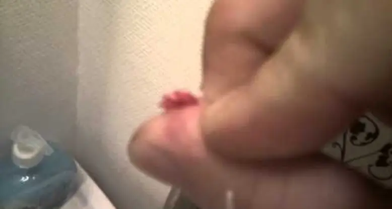 Popping A Gigantic Finger Cyst