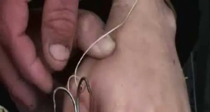 Removing A Treble Hook From A Man’s Hand