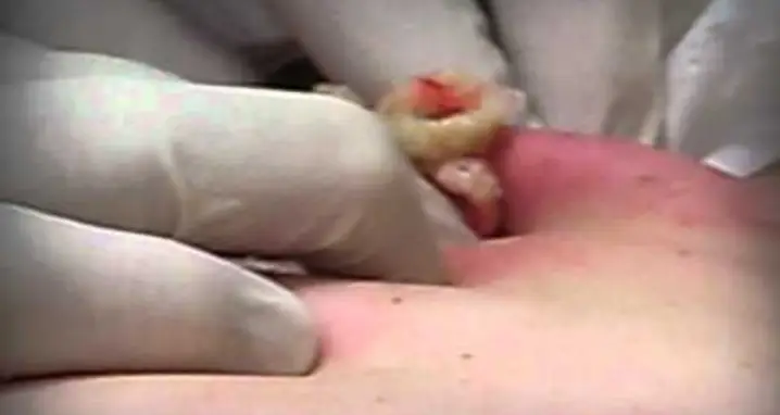 Popping The Biggest Cyst On The Planet