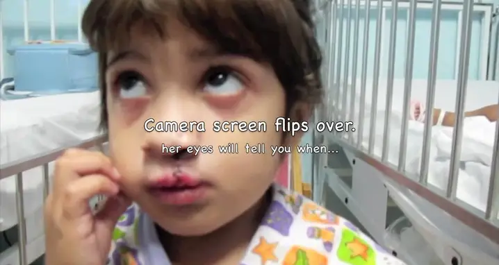 Little Girl Sees Herself After Cleft Surgery